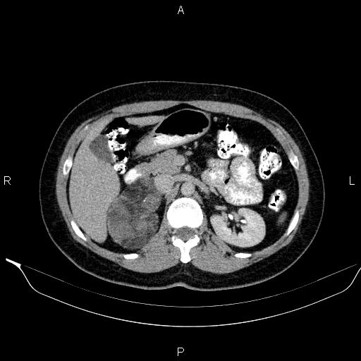 Bilateral adrenal myelolipoma (Radiopaedia 63058-71535 Axial C+ delayed 38).jpg