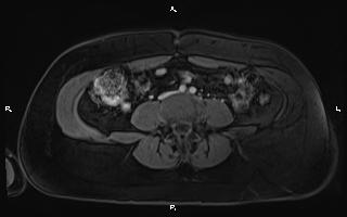Bilateral adrenal myelolipoma (Radiopaedia 63058-71537 G 73).jpg