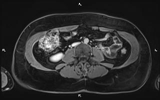 File:Bilateral adrenal myelolipoma (Radiopaedia 63058-71537 H 66).jpg