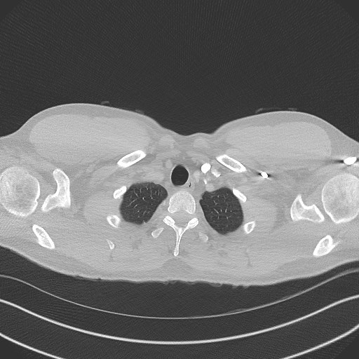 File:Bilateral atelectasis (Radiopaedia 48666-53675 Axial lung window 5).jpg