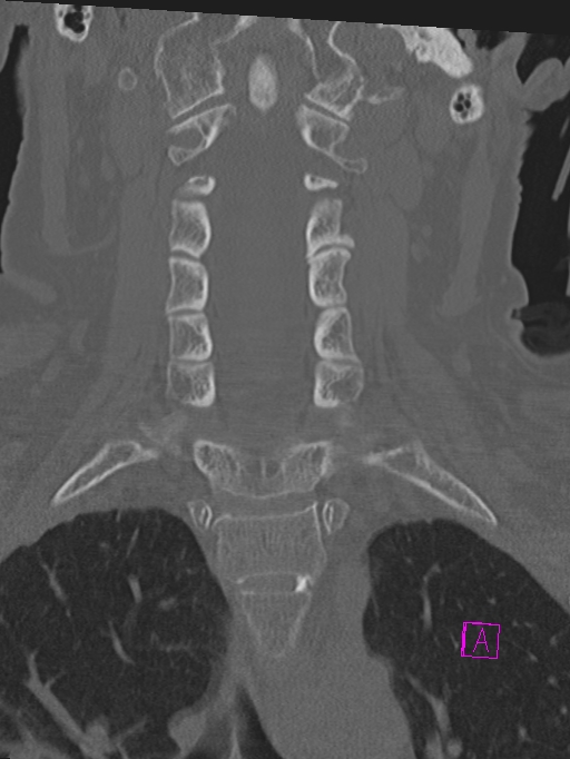 Bilateral atlanto-occipital assimilation (Radiopaedia 28350-28603 Coronal bone window 19).jpg