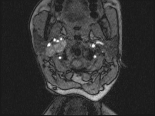 Bilateral carotid body tumors and right glomus jugulare tumor (Radiopaedia 20024-20060 Axial MRA 282).jpg