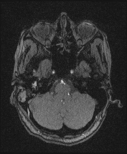 Bilateral carotid body tumors and right glomus jugulare tumor (Radiopaedia 20024-20060 Axial MRA 40).jpg