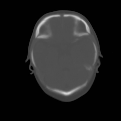 File:Bilateral cephalohematomas and subdural hematomas (Radiopaedia 26778-26929 Axial bone window 4).jpg