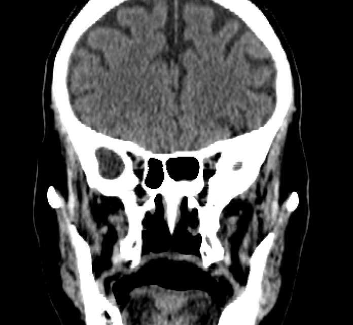 Bilateral ectopia lentis (Radiopaedia 89889-107013 Coronal non-contrast 100).jpg