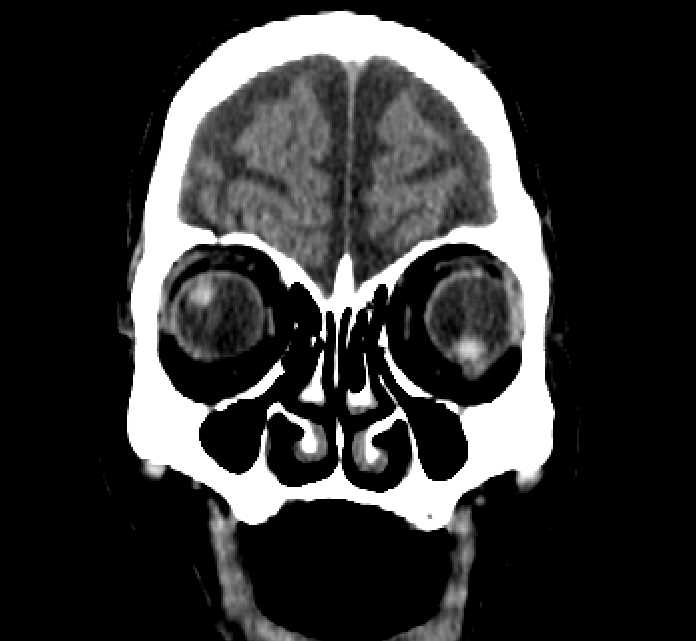 Bilateral ectopia lentis (Radiopaedia 89889-107013 Coronal non-contrast 42).jpg