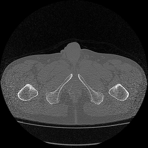 Bilateral femoral neck stress fractures (Radiopaedia 28666-28954 Axial bone window 80).png