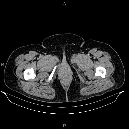 Bilateral ovarian dermoid cysts (Radiopaedia 85785-101603 A 118).jpg