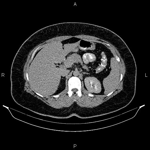 Bilateral ovarian dermoid cysts (Radiopaedia 85785-101603 Axial C+ delayed 18).jpg