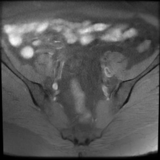 File:Bilateral ovarian dermoid cysts (Radiopaedia 90152-107338 Axial T1 fat sat 6).jpg