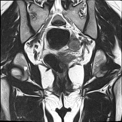 File:Bilateral ovarian endometriomas (Radiopaedia 87085-103347 Coronal T2 14).jpg