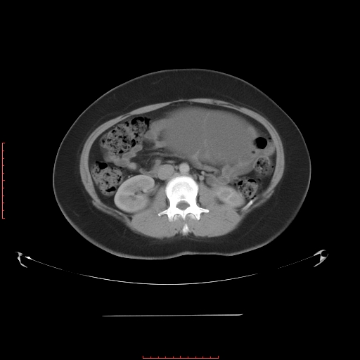 File:Bilateral ovarian serous cystadenocarcinoma with right ovarian torsion (Radiopaedia 32640-33611 A 19).jpg