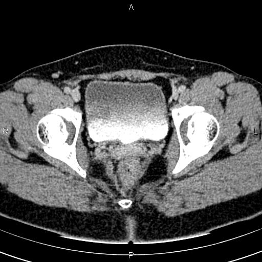 Bilateral ovarian teratoma (Radiopaedia 83131-97503 B 65).jpg
