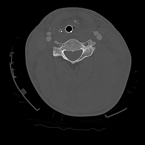 File:Bilateral perched facets with cord injury (Radiopaedia 45587-49713 Axial bone window 56).jpg
