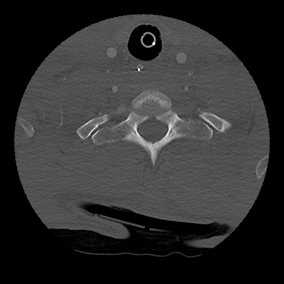 File:Bilateral perched facets with cord injury (Radiopaedia 45587-49713 Axial bone window 90).jpg