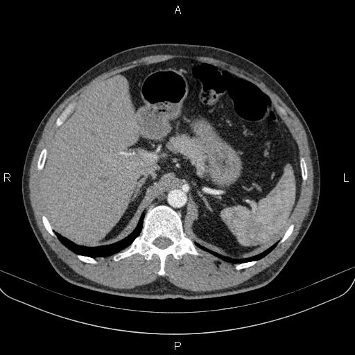 Bilateral pulmonary AVM (Radiopaedia 83134-97505 A 74).jpg