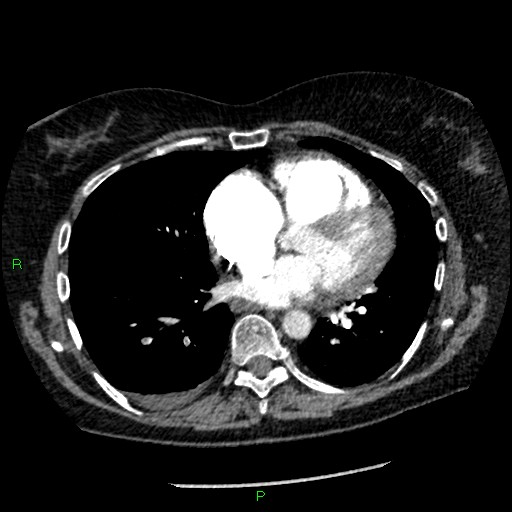 File:Bilateral pulmonary emboli (Radiopaedia 32700-33669 Axial C+ CTPA 68).jpg