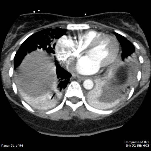 Bilateral pulmonary emboli with Hampton hump sign (Radiopaedia 54070-60246 Axial C+ CTPA 48).jpg