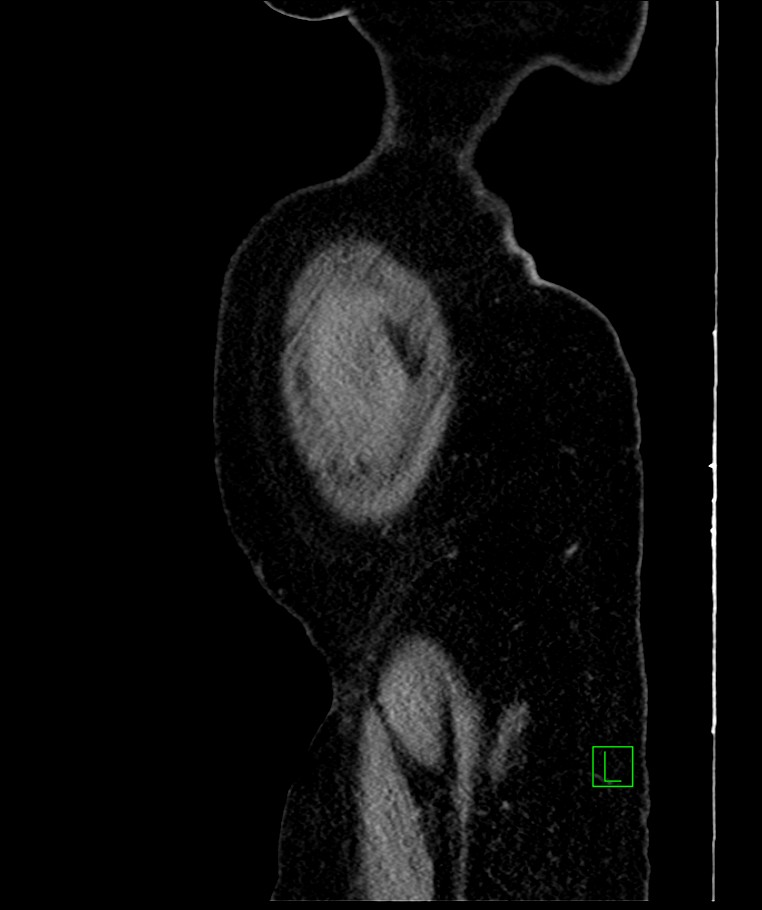 Bilateral sporadic synchronous clear cell renal cell carcinoma (Radiopaedia 85035-100575 E 117).jpg