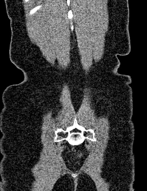 Bilateral staghorn calculi (Radiopaedia 59475-66842 Coronal non-contrast 89).jpg