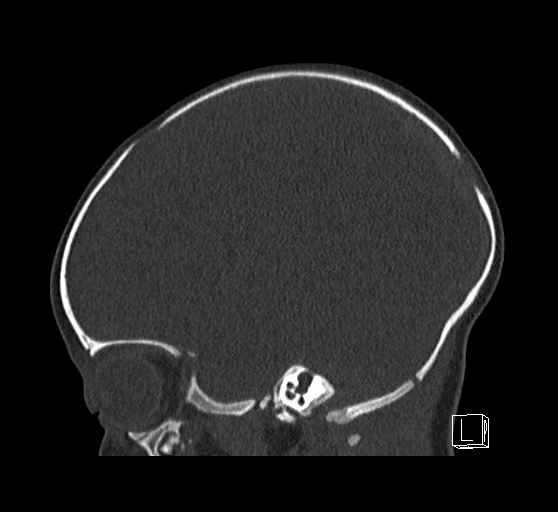 Bilateral subdural hemorrhage and parietal skull fracture (Radiopaedia 26058-26192 Sagittal bone window 31).png