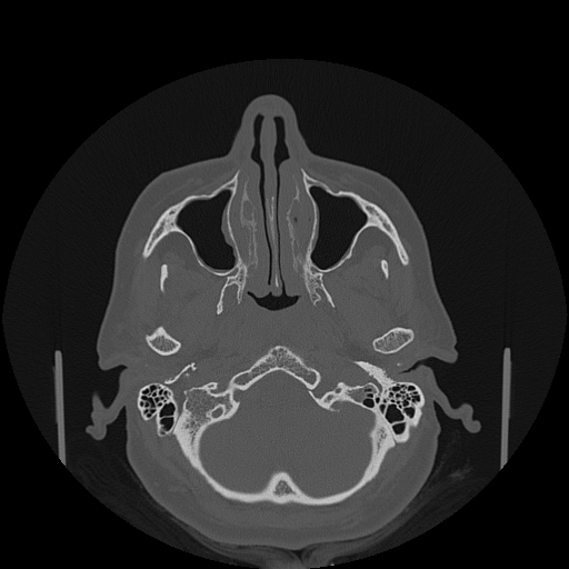 File:Bisphosphonate-related osteonecrosis of the jaw (Radiopaedia 71324-81642 Axial bone window 139).jpg