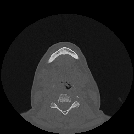 File:Bisphosphonate-related osteonecrosis of the jaw (Radiopaedia 71324-81642 Axial bone window 20).jpg