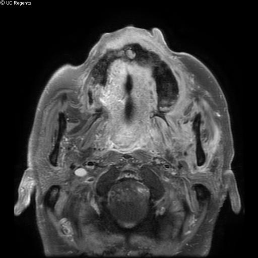 Bisphosphonate-related osteonecrosis of the maxilla (Radiopaedia 51367-57101 Axial T1 C+ fat sat 20).jpg