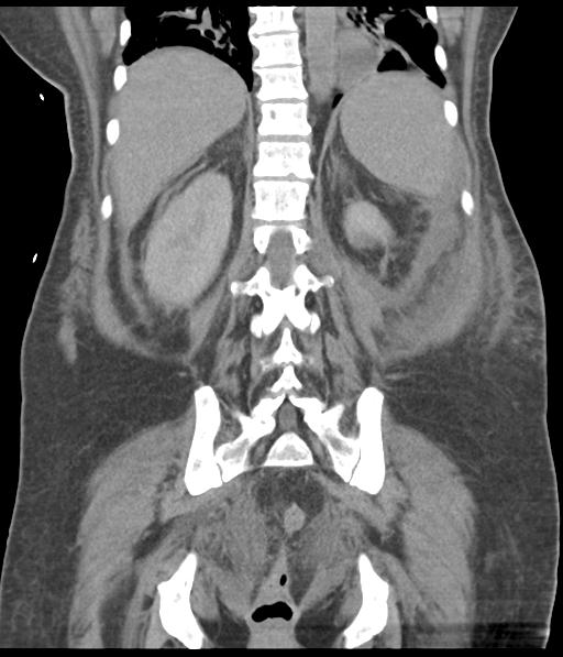 File:Bladder rupture post renal biopsy (Radiopaedia 30863-31572 Coronal non-contrast 44).jpg