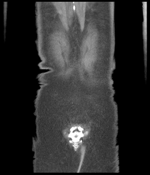 Bladder rupture post renal biopsy (Radiopaedia 30863-31572 Coronal non-contrast 54).jpg