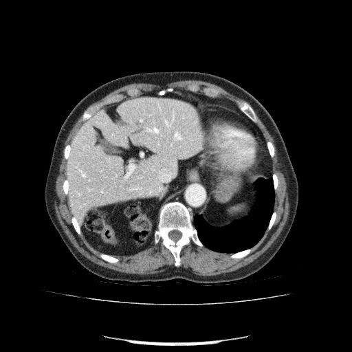 File:Bladder tumor detected on trauma CT (Radiopaedia 51809-57609 B 29).jpg
