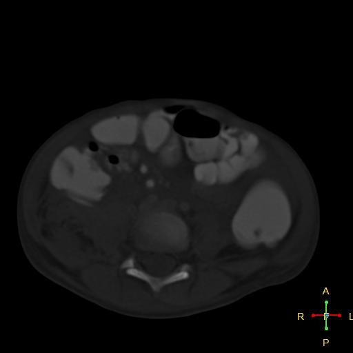 File:Blunt abdominal trauma (Radiopaedia 24780-25044 Axial bone window 2).jpg