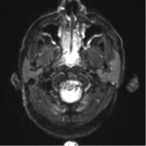 File:Blunt cerebrovascular injury (Radiopaedia 53682-59745 Axial DWI 3).png