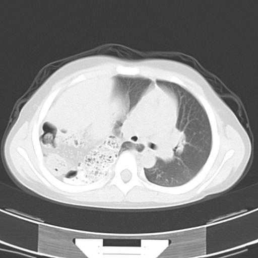 File:Bochdalek diaphragmatic hernia (Radiopaedia 38866-41059 Axial lung window 10).jpg