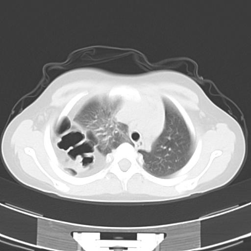 File:Bochdalek diaphragmatic hernia (Radiopaedia 38866-41059 Axial lung window 6).jpg