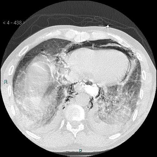 File:Boerhaave syndrome (Radiopaedia 27683-27897 lung window 72).jpg