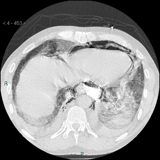 Boerhaave syndrome (Radiopaedia 27683-27897 lung window 85).jpg