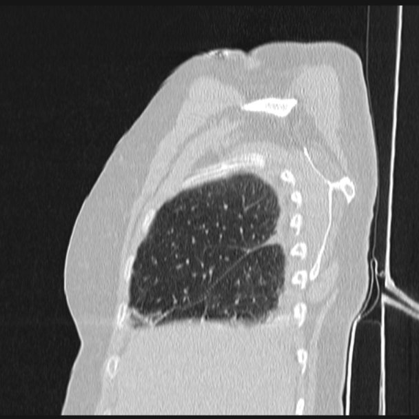 Boerhaave syndrome (Radiopaedia 45644-49799 Sagittal lung window 12).jpg