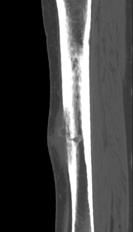Bone metastasis - tibia (Radiopaedia 57665-64609 Sagittal bone window 92).jpg