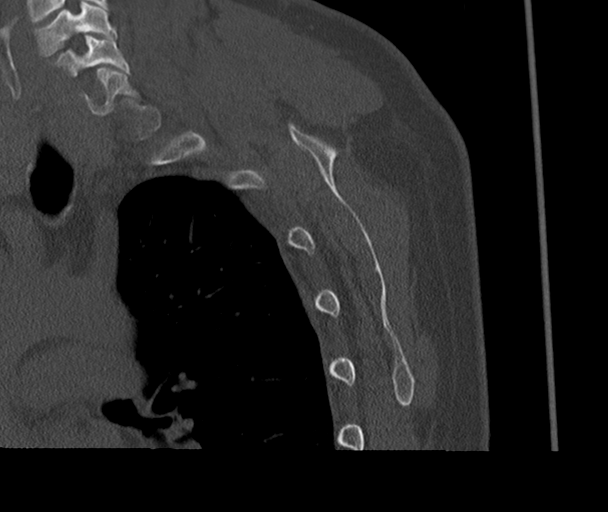 Bony Bankart and Hill-Sachs lesions (Radiopaedia 33622-34727 Sagittal bone window 67).png