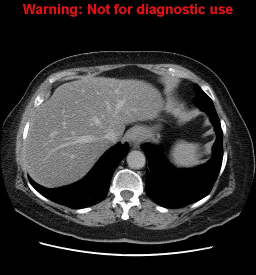 File:Bosniak renal cyst - type II (Radiopaedia 23404-23468 F 10).jpg