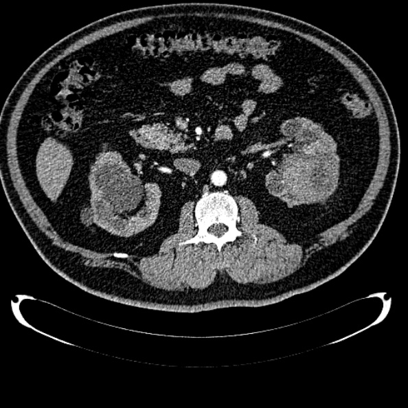 Bosniak renal cyst - type IV (Radiopaedia 24244-24518 B 148).jpg