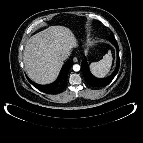 Bosniak renal cyst - type IV (Radiopaedia 24244-24518 B 35).jpg