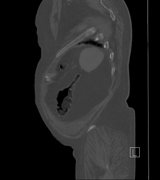 File:Bowel ischemia secondary to SMA occlusion with extensive portomesenteric venous gas (Radiopaedia 54656-60871 Sagittal bone window 11).jpg