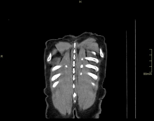 Brachial artery foreign body (Radiopaedia 54583-60820 Coronal non-contrast 59).jpg