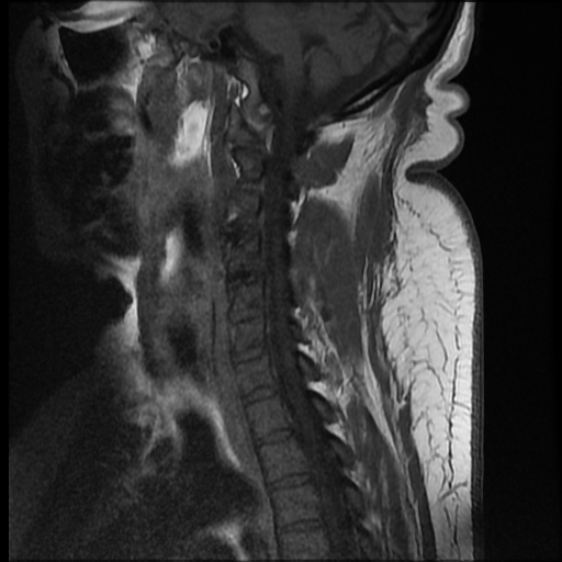 File:Brachial plexopathy (Radiopaedia 21844-21806 Sagittal T1 C+ 4).jpg