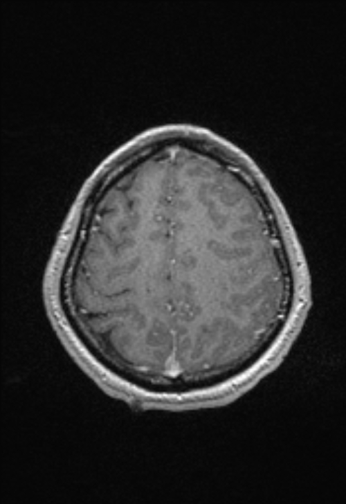 Brain abscess with ventriculitis (Radiopaedia 85703-101495 Axial T1 C+ 139).jpg