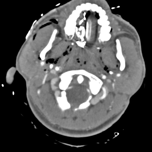 Brain contusions, internal carotid artery dissection and base of skull fracture (Radiopaedia 34089-35339 D 53).png