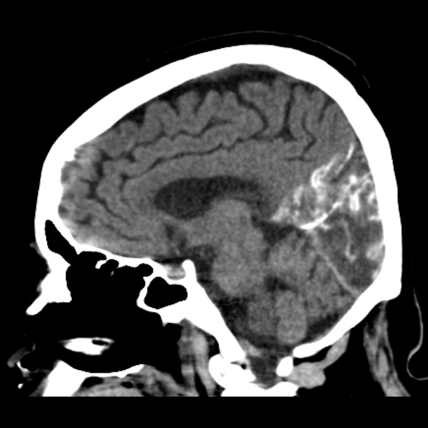 Brain cortical laminar necrosis (Radiopaedia 25822-25971 non-contrast 28).jpg