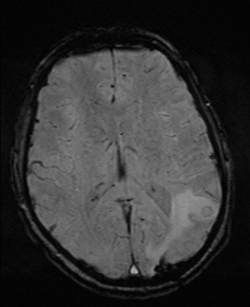 Brain metastases - lung cancer primary (Radiopaedia 75060-86115 Axial SWI 35).jpg